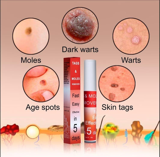 Skin Tag & Mole Remover Pen – Safe, Painless Skin Correction at Home
